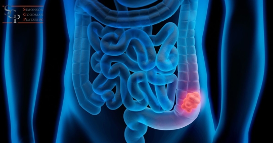 Medical image showing colon cancer